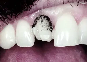 خرید و دانلود نسخه کامل کتاب Tooth-Colored Restorations: Underlying Physics