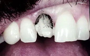 خرید و دانلود نسخه کامل کتاب Tooth-Colored Restorations: Underlying Physics_6a685365d179b.webp خرید و دانلود نسخه کامل کتاب Tooth-Colored Restorations: Underlying Physics