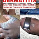خرید و دانلود نسخه کامل کتاب Contact Dermatitis (Dermatology)