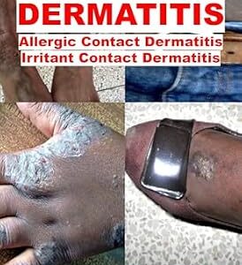 خرید و دانلود نسخه کامل کتاب Contact Dermatitis (Dermatology)