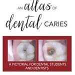 خرید و دانلود نسخه کامل کتاب An Atlas of Dental Caries: A Pictorial For Dental Students and Dentists